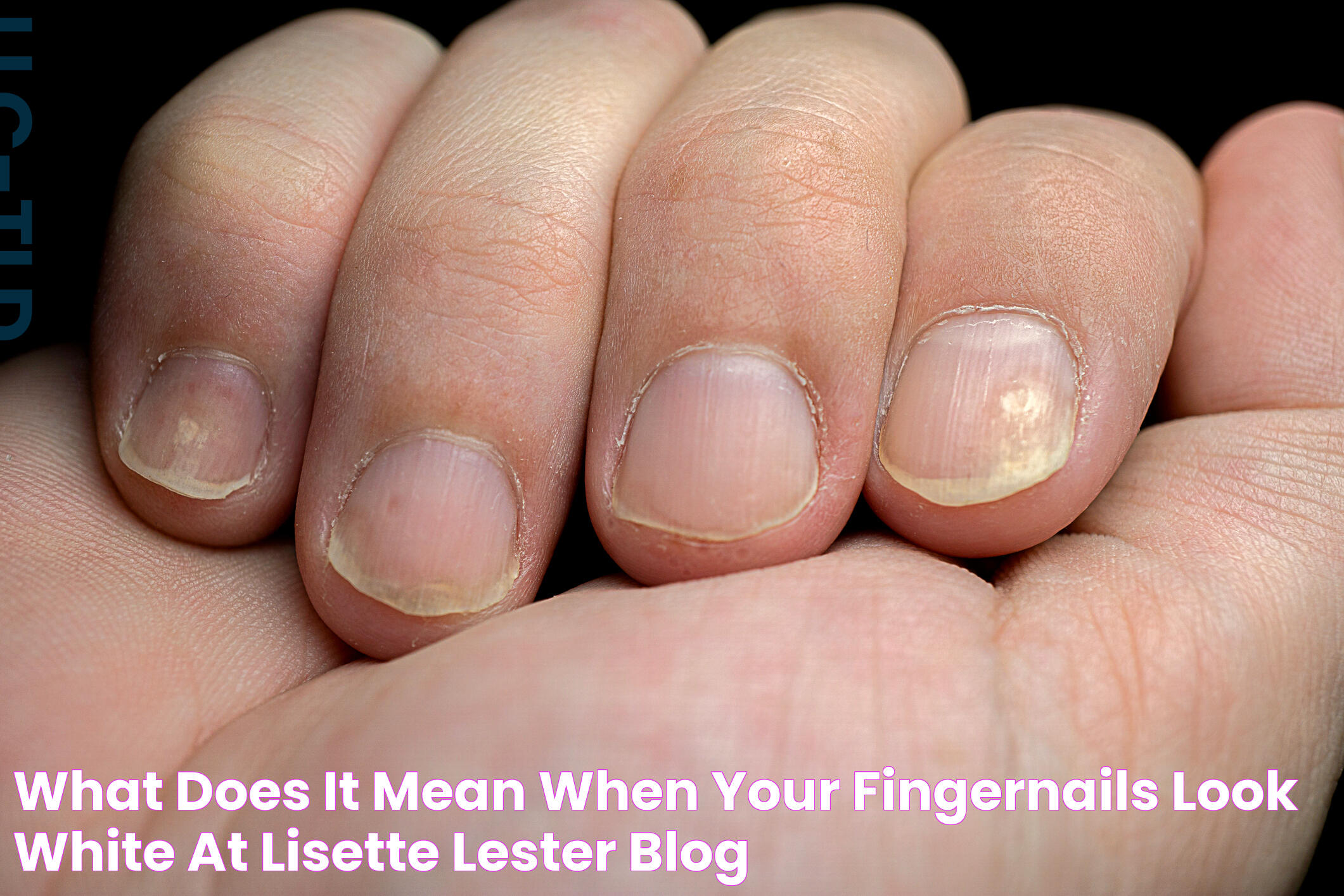 White Fingernails: Symbolism, Health, And More