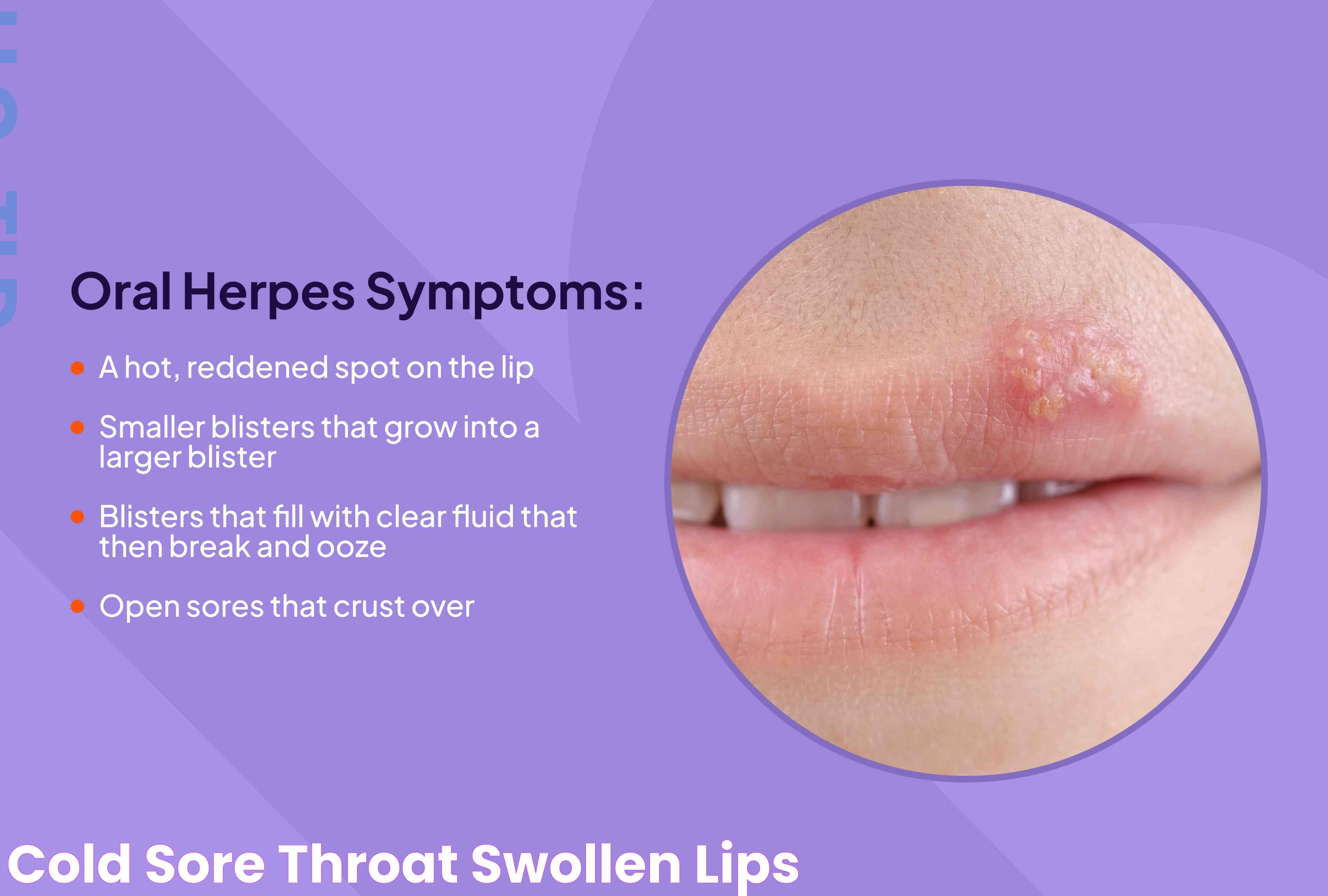 Cold Sore On Top Of Bottom Lip: Treatment And Prevention Tips