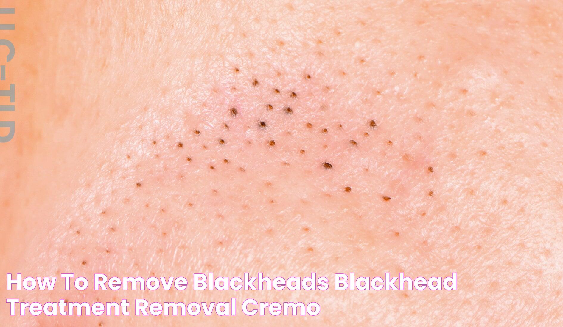 Effective Tips For How To Remove Blackheads From Back