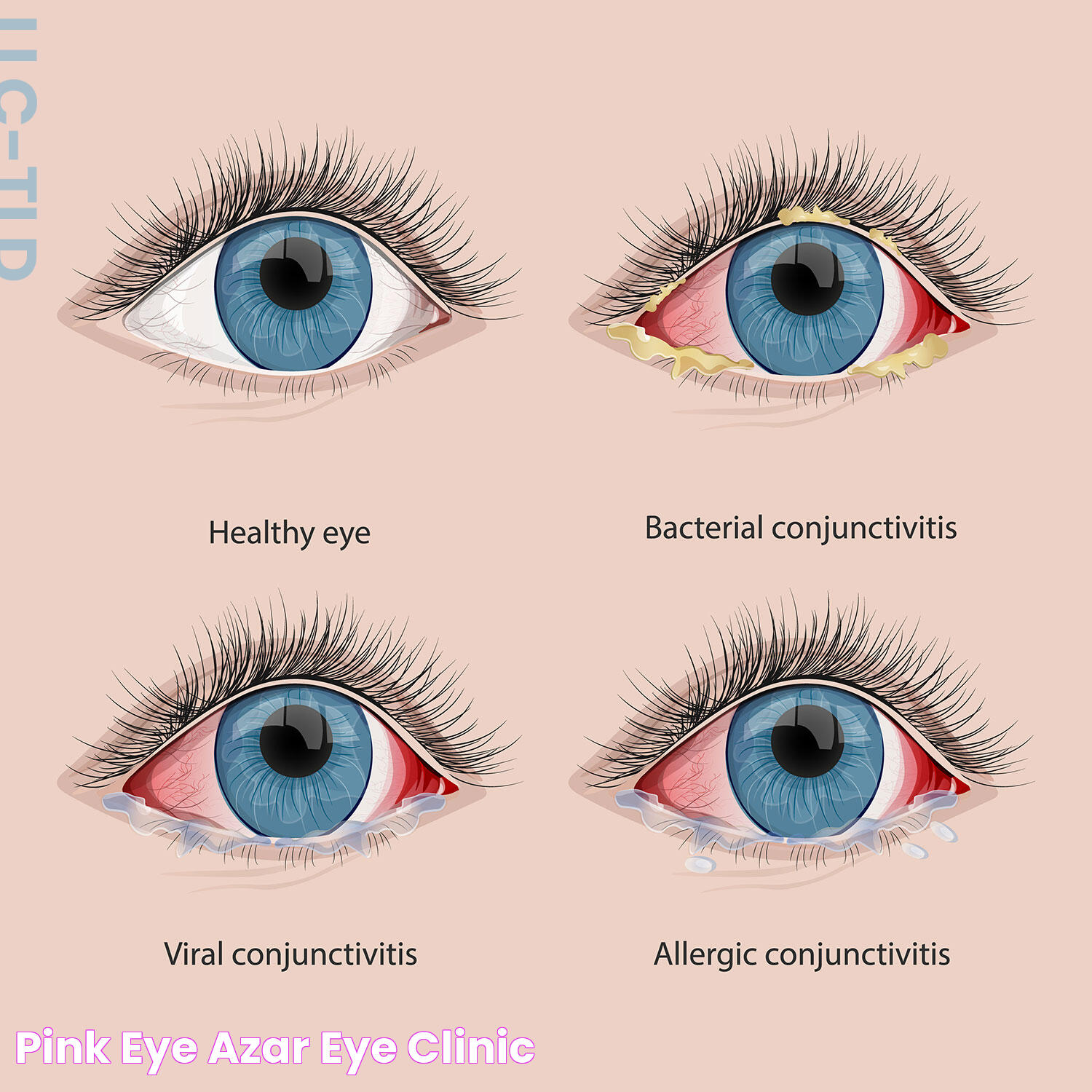 Effective Solutions For Pink Eye Relief