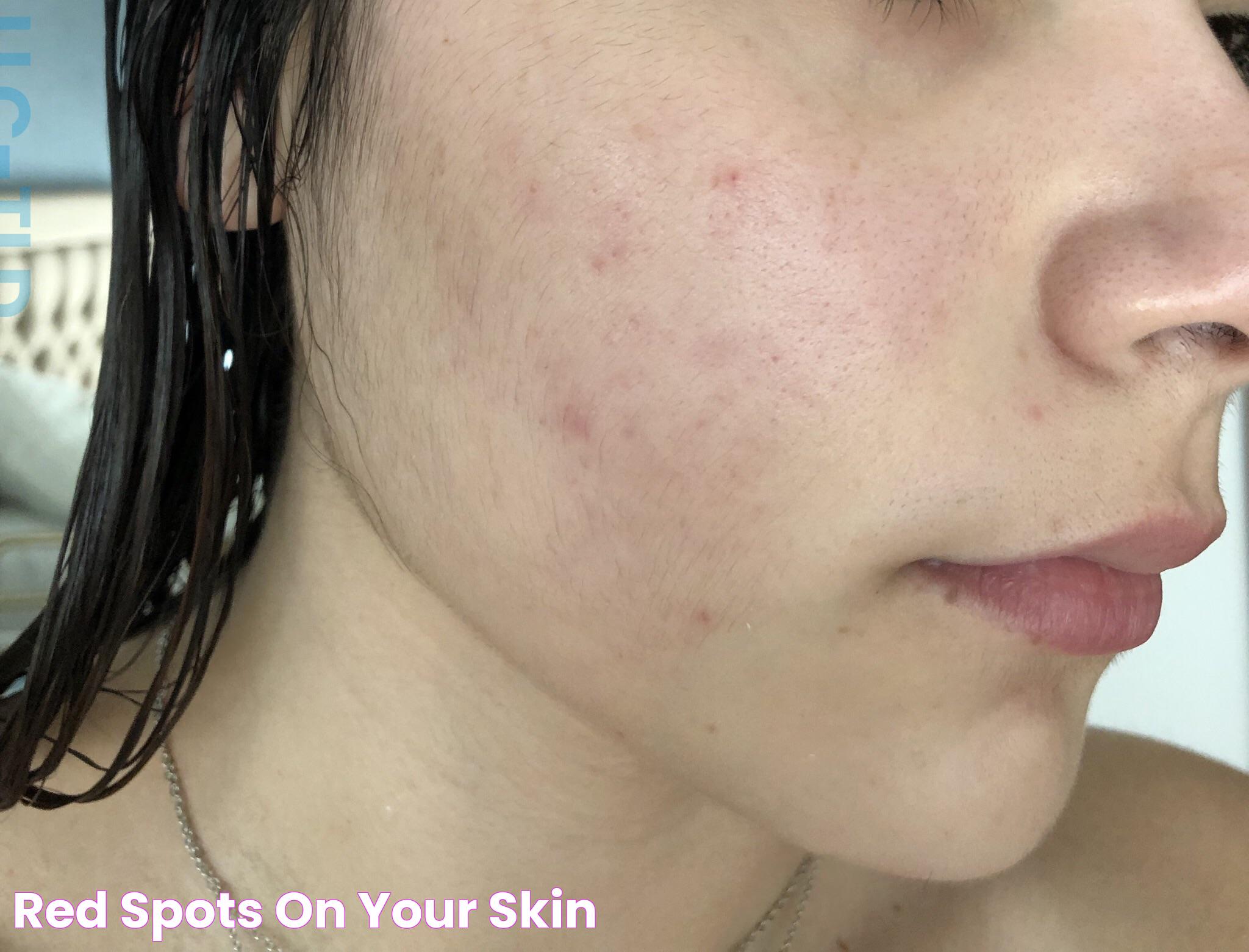 All About Flat Red Spots On Skin: Causes, Treatments, And Prevention