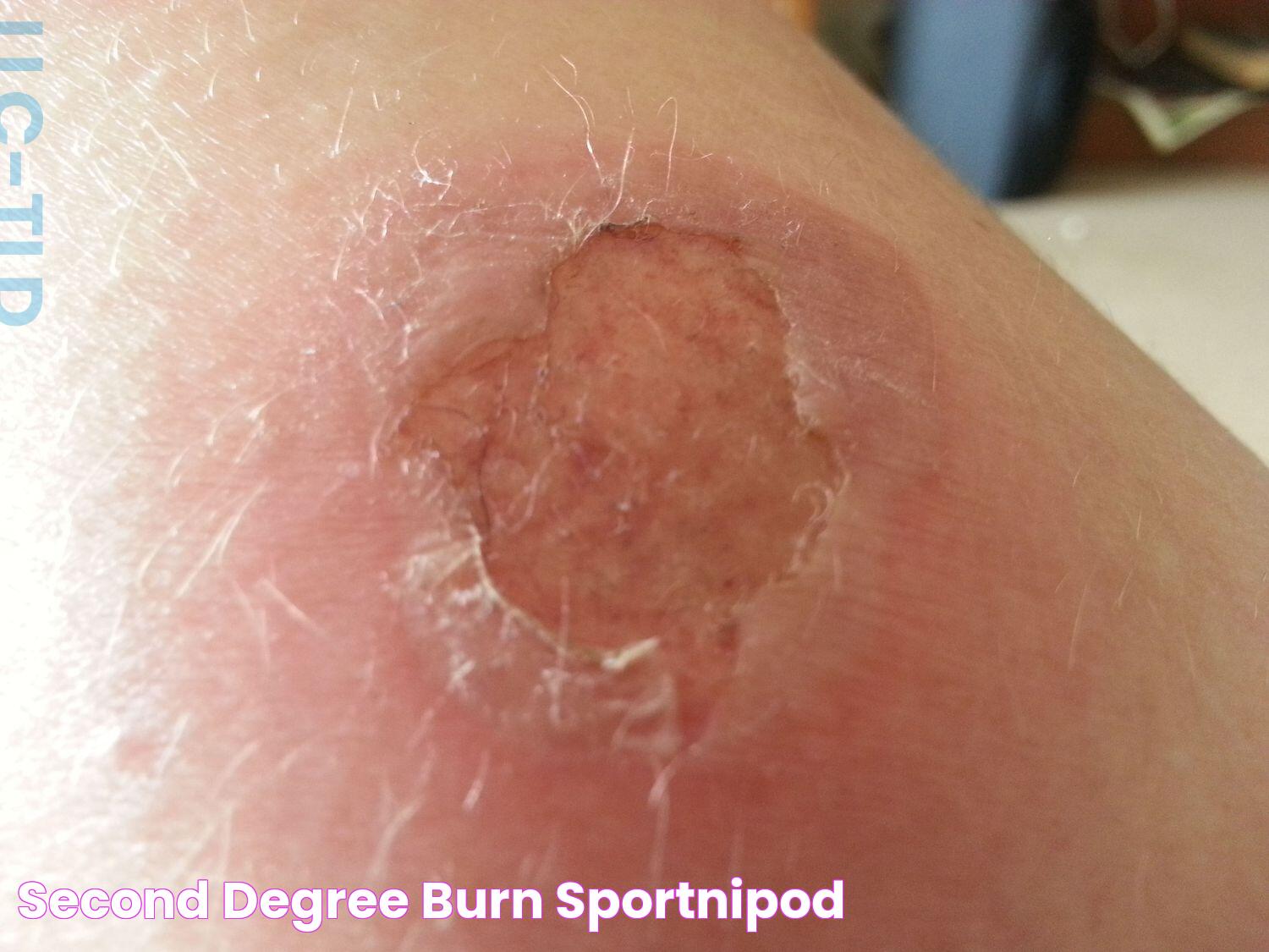 Effective Treatments And Insights For 2nd Degree Burn Scars