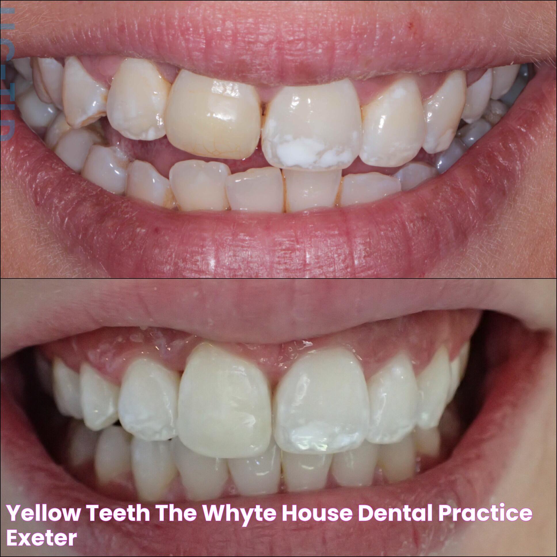 Whiter Smiles: The Causes And Solutions For Yellow Teeth