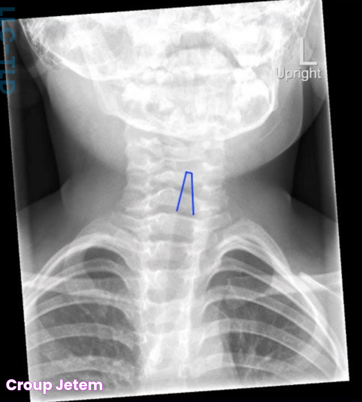 Decoding Differences: Croup Vs Pertussis