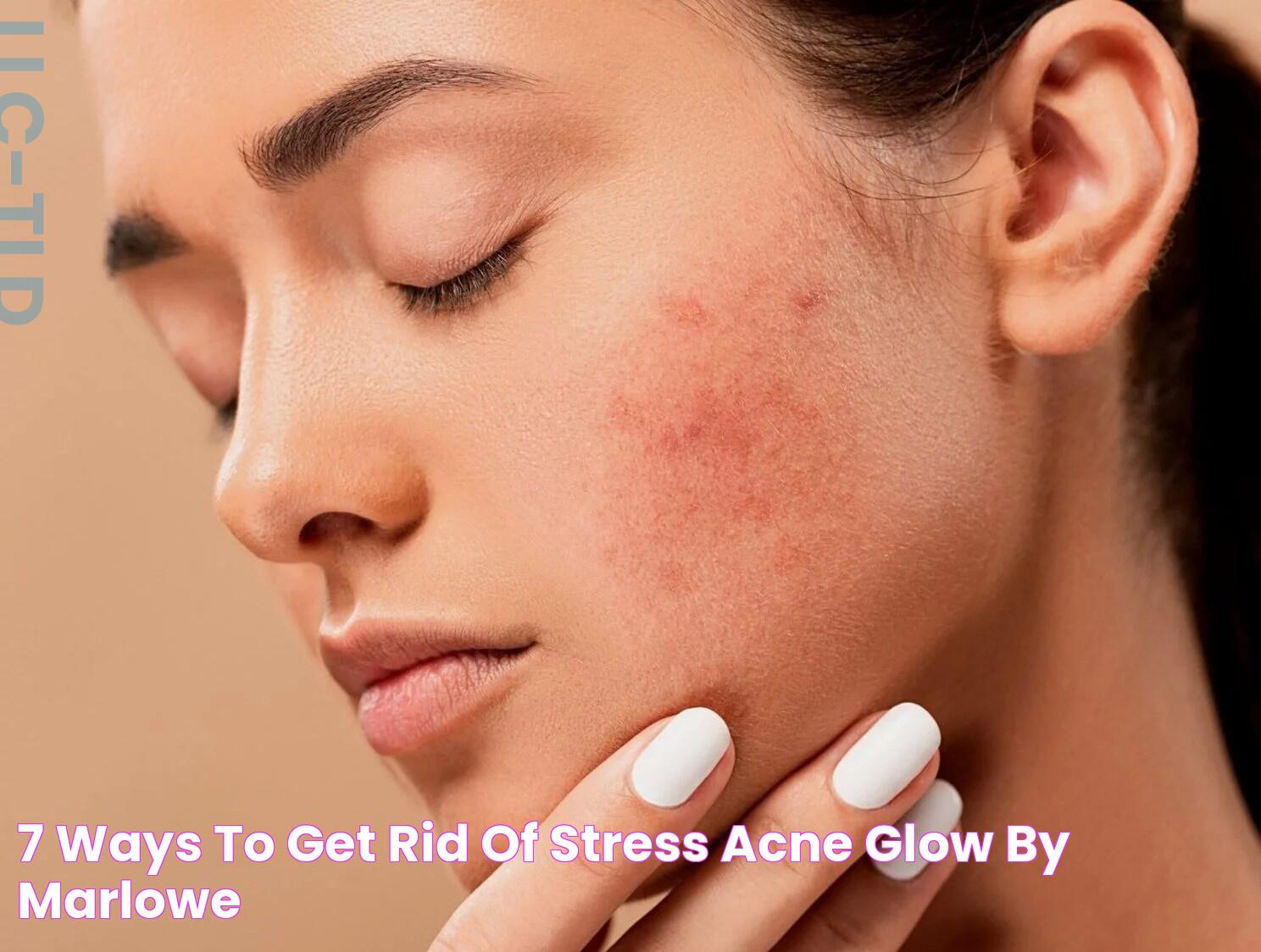 Combatting Stress Acne: Effective Solutions For Clear Skin