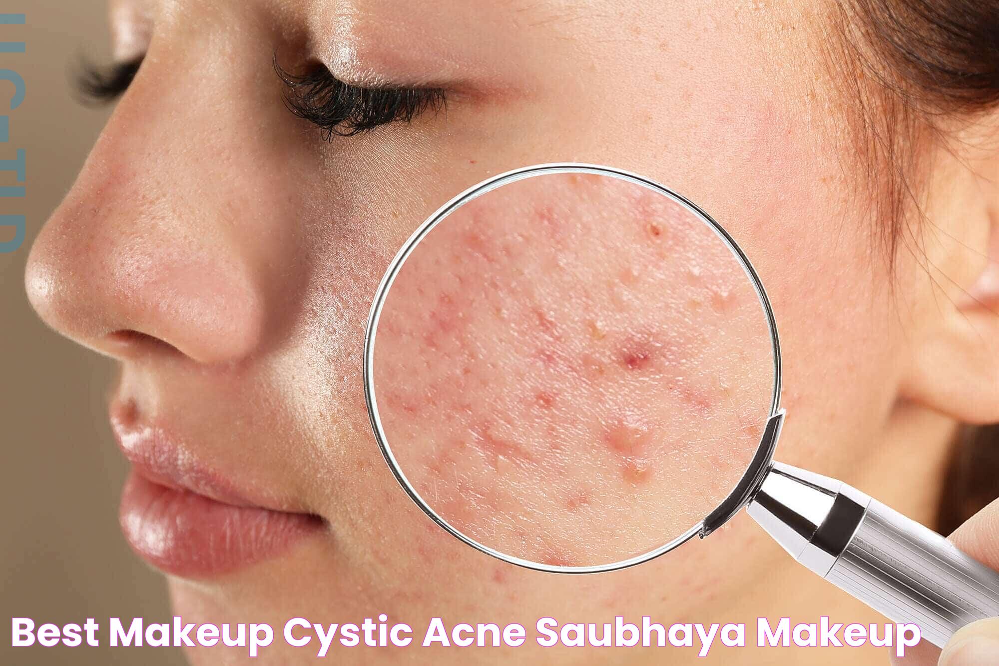 Understanding Cystic Acne: Causes, Treatments &amp; Prevention Tips