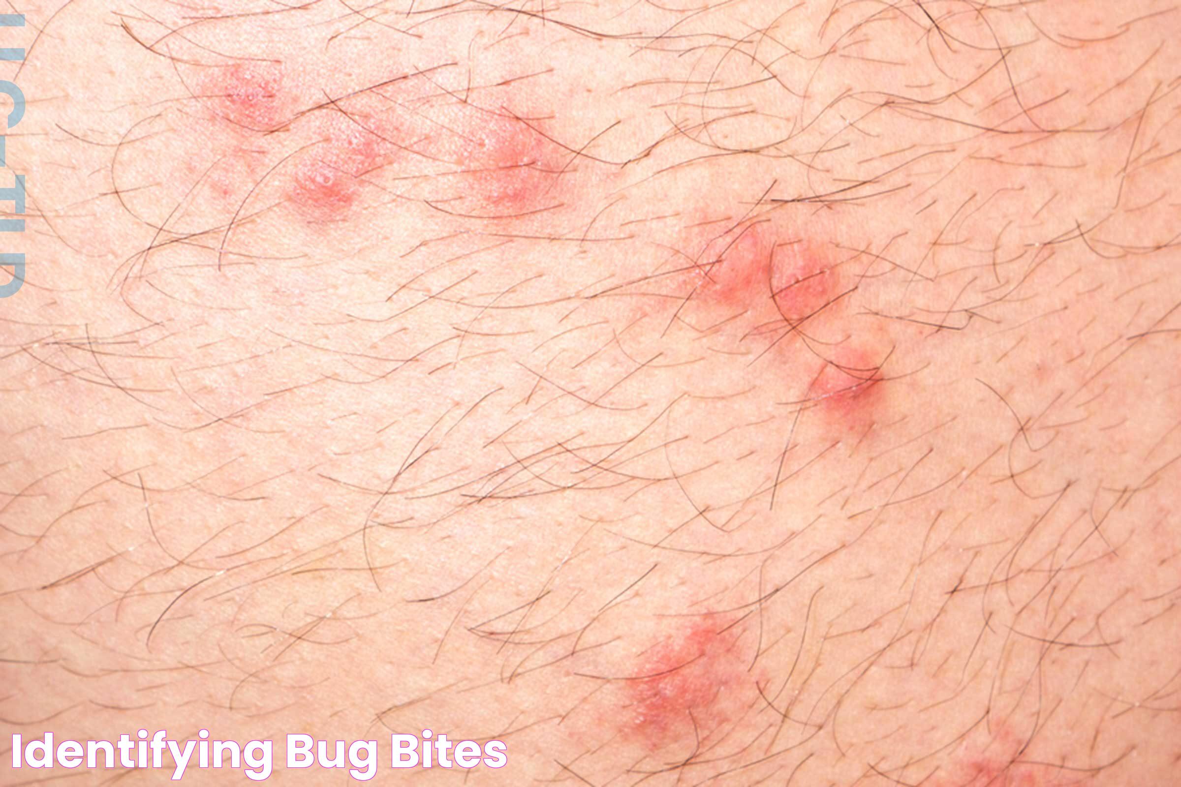 All You Need To Know About Bug Bites: Prevention, Treatment, And More