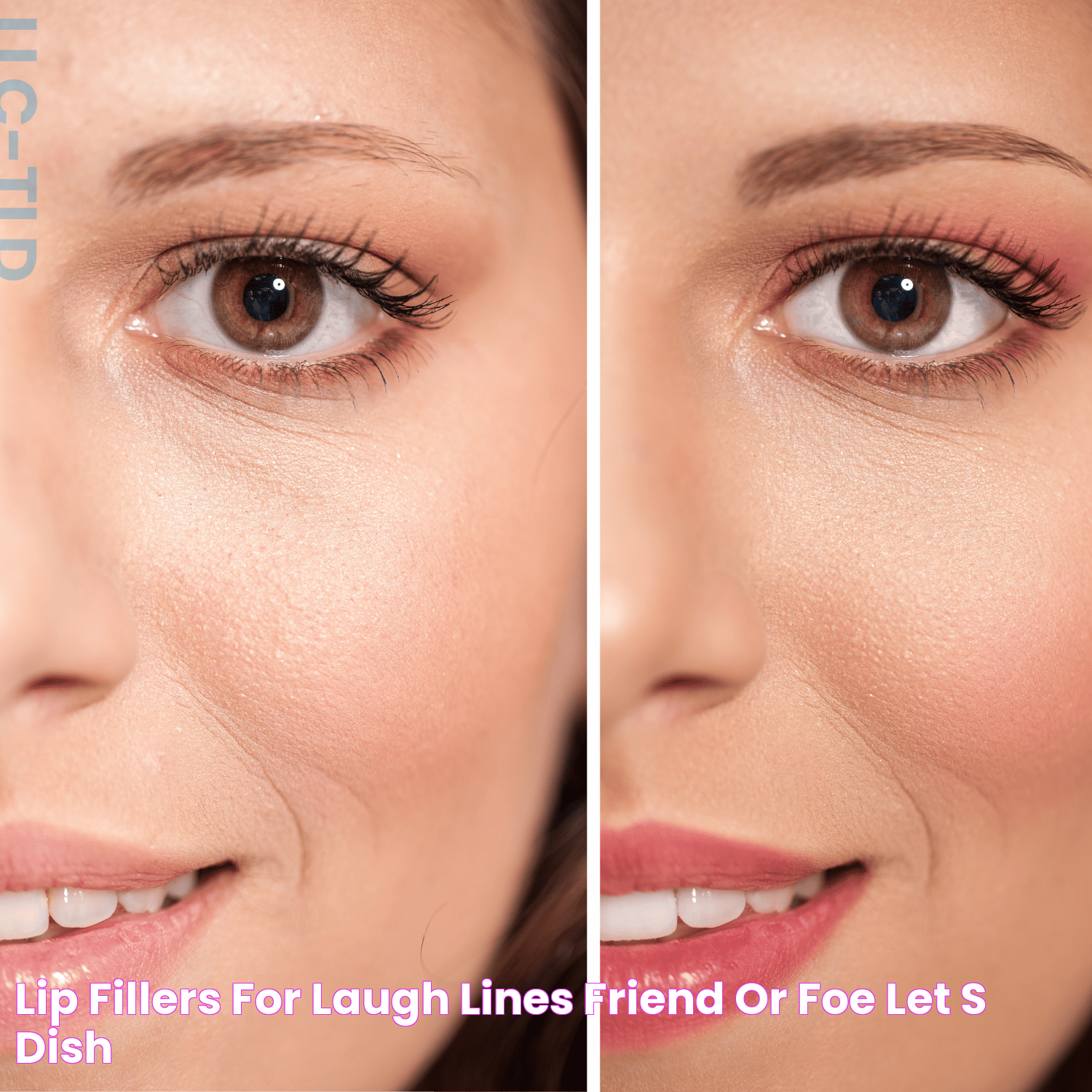 Transforming Your Look: Fillers In Laugh Lines For A Youthful Glow