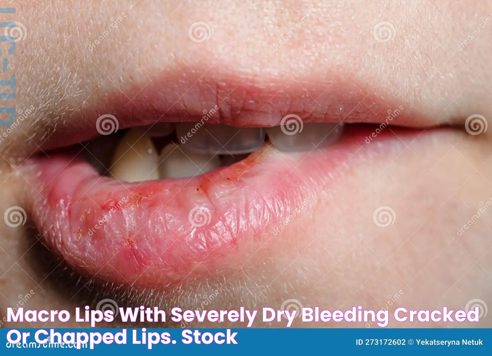 Causes And Remedies For Severely Chapped Lips