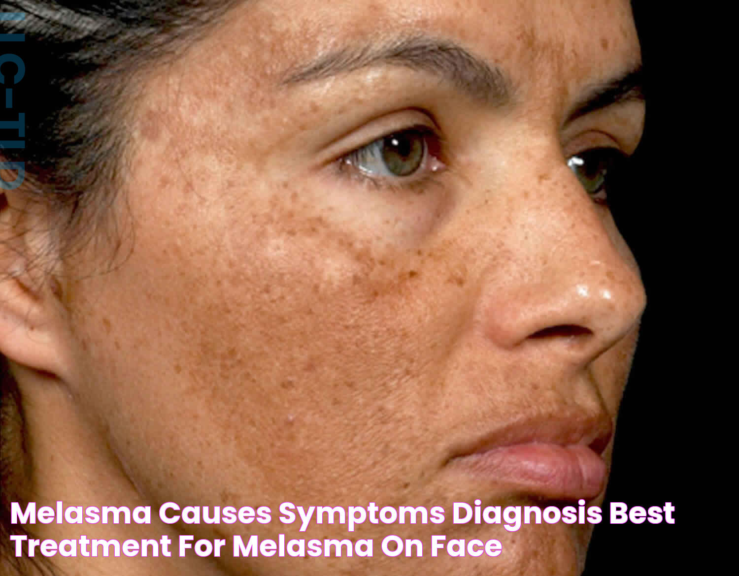 Melasma: A Comprehensive Guide To Understanding And Managing Skin Discoloration