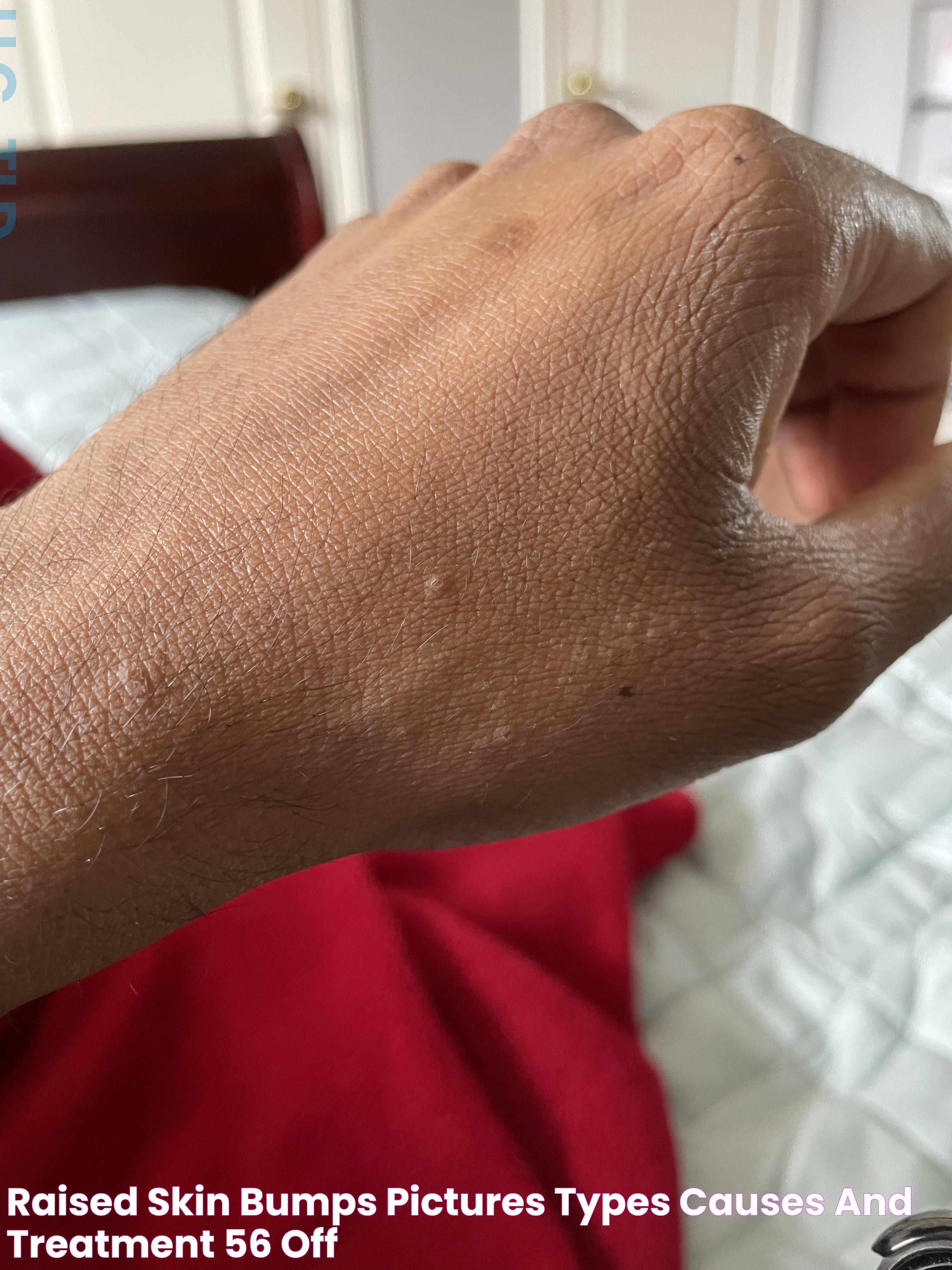 All You Need To Know About Small Hard White Bumps On Skin