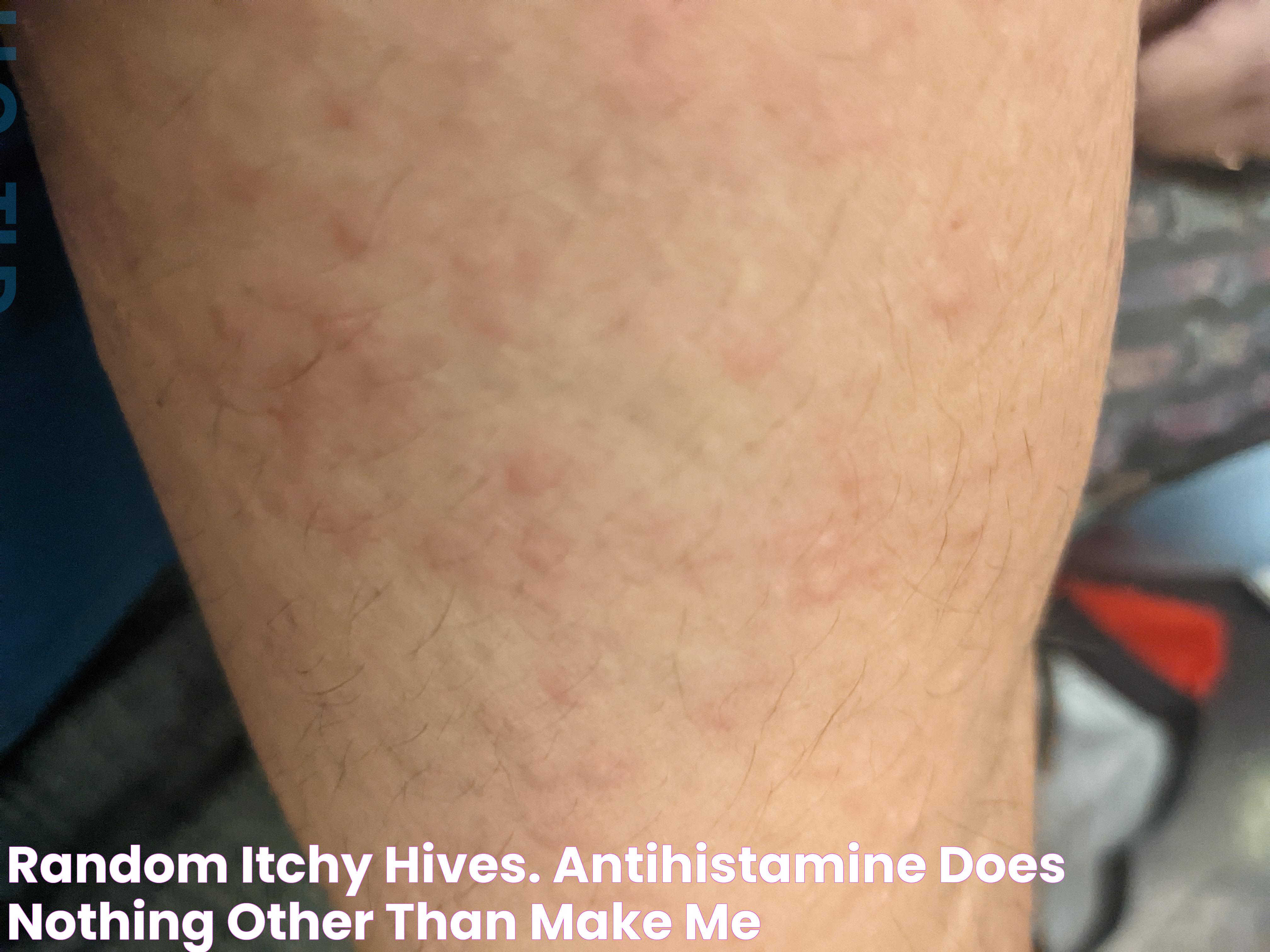 Antihistamines: Do They Lead To Dryness In Your Body?