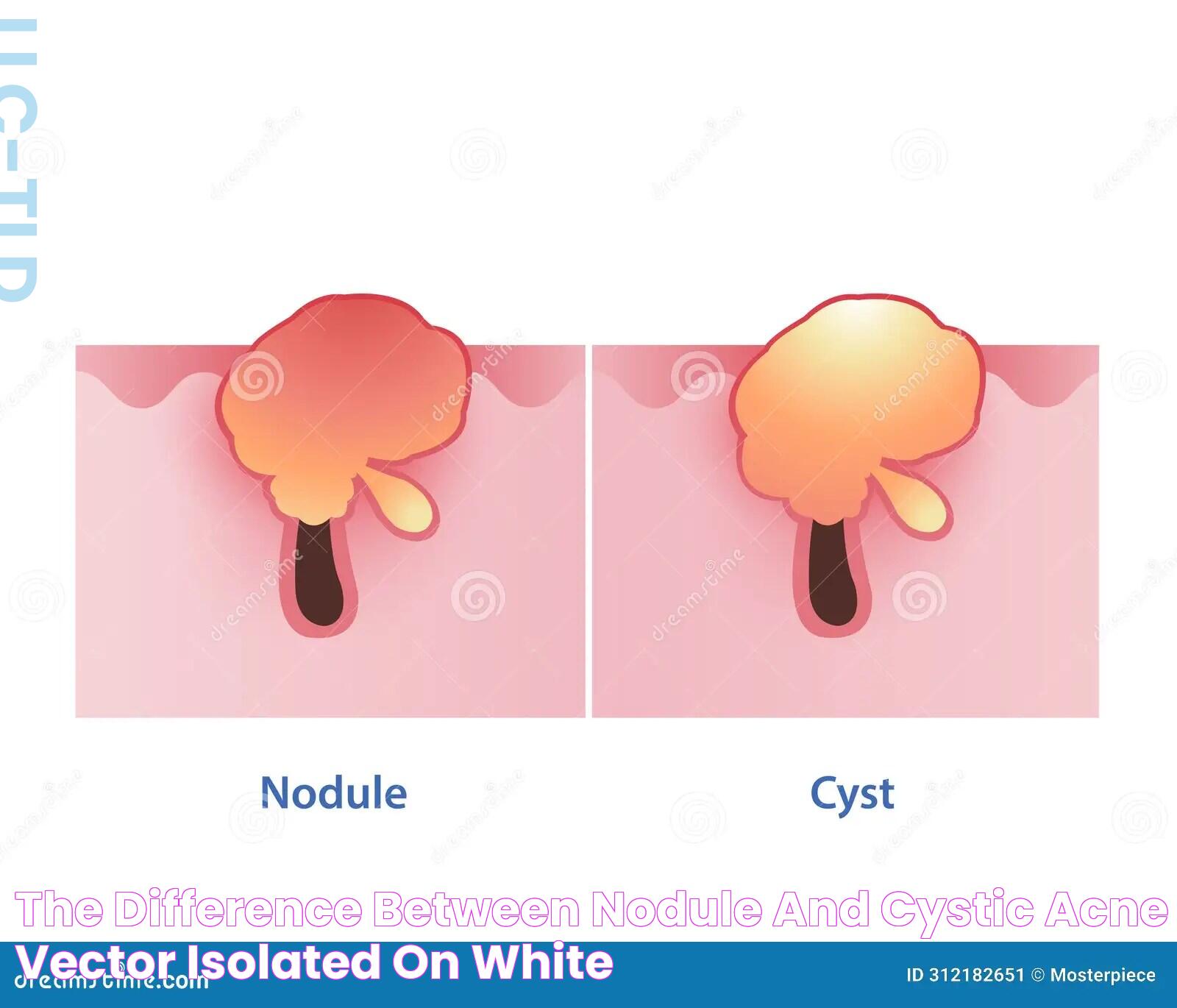 White Bump Cyst: A Comprehensive Guide To Symptoms, Causes, And Treatments