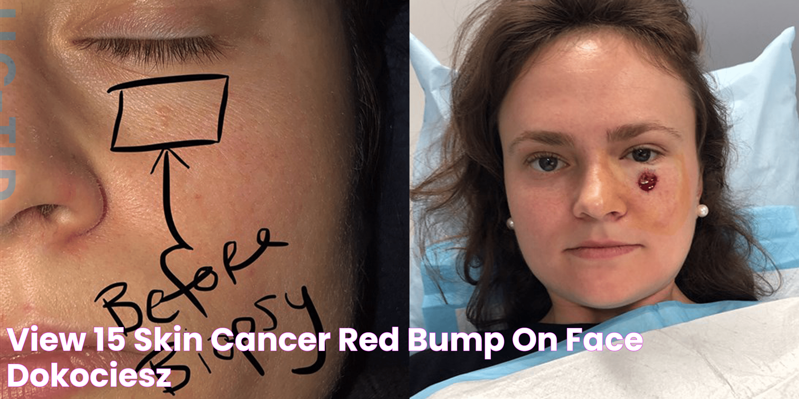 Skin Cancer Red Bump: Prevention, Symptoms &amp; Treatment