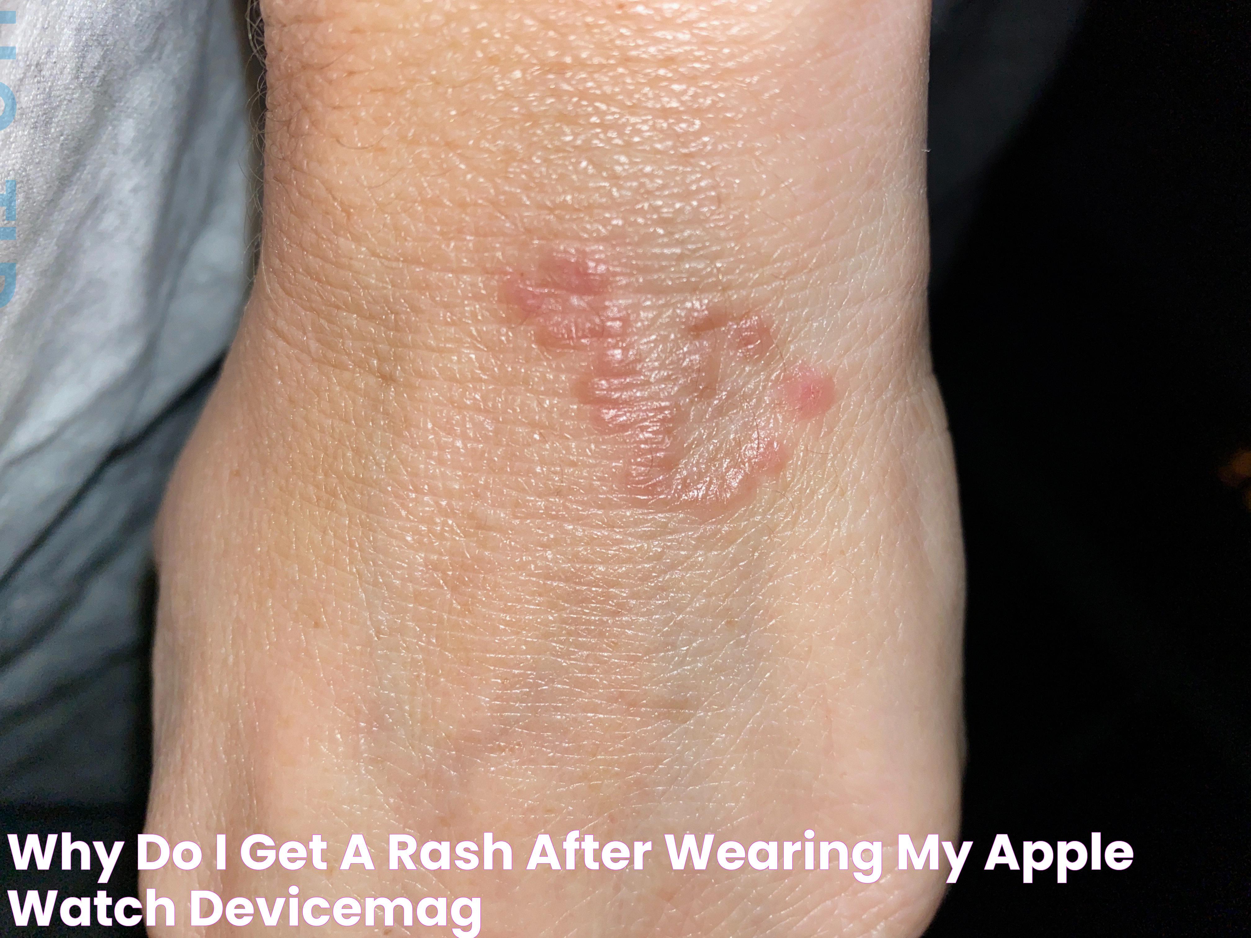 Apple Watch Giving Me A Rash: Solutions And Prevention Tips