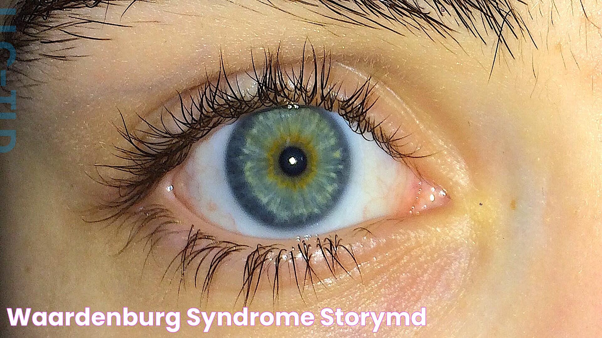 Waardenburg Syndrome: Causes, Symptoms, And Management